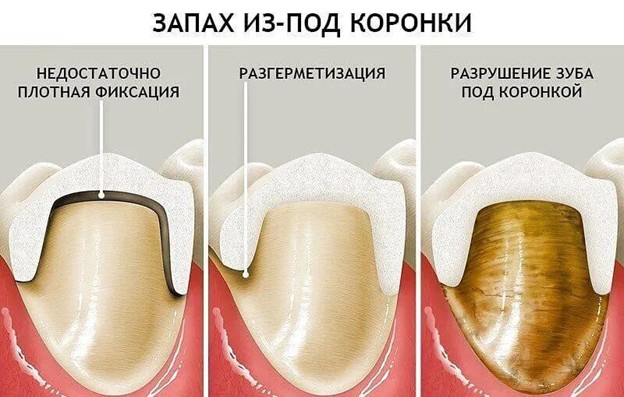 иллюстрация причин запаха из под коронки