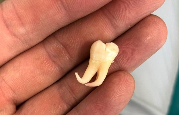 В руке выпавший зуб