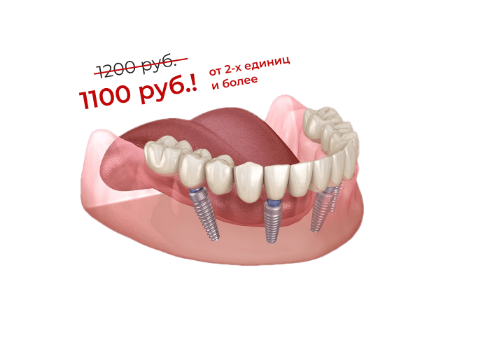 Безметалловые (оксид циркония) коронки на корейских имплантатах OSSTEM, MEGAGEN