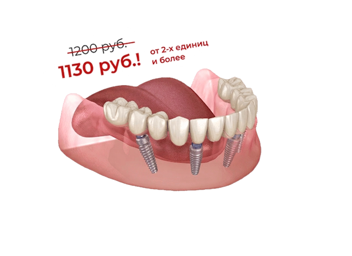 Безметалловые (оксид циркония) коронки на корейских имплантатах OSSTEM, MEGAGEN